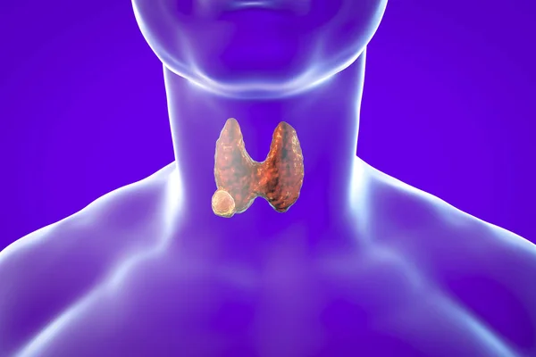 Thyroid cancer. illustration — Stock Photo, Image