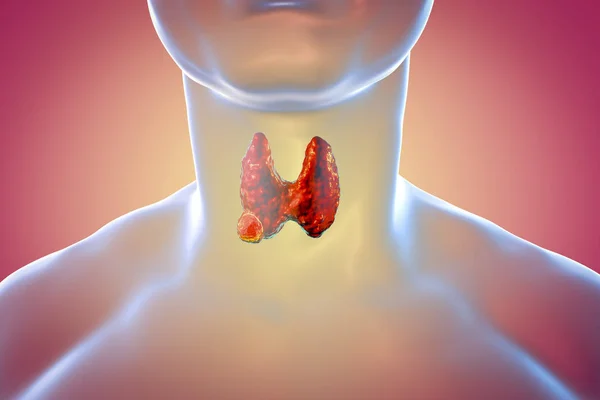 Cancer de la thyroïde. illustration — Photo