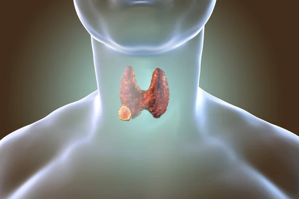 Thyroid cancer. illustration — Stock Photo, Image