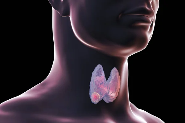 Cancer de la thyroïde. illustration — Photo