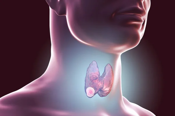 Cancer de la thyroïde. illustration — Photo