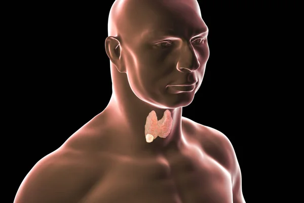 Thyroid cancer. illustration — Stock Photo, Image