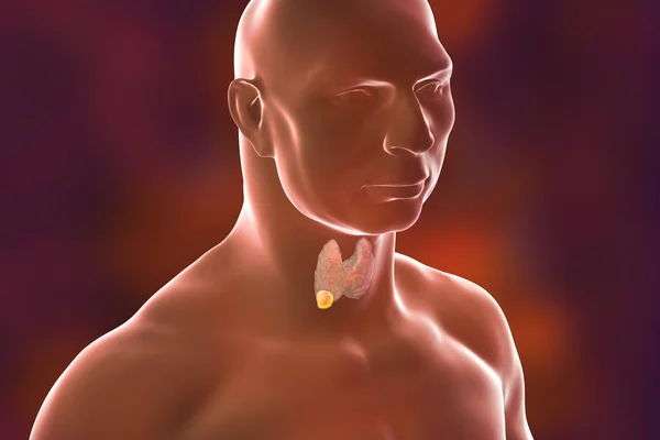 Рак щитовидной железы. иллюстрация — стоковое фото