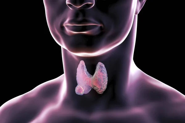 Thyroid cancer. illustration — Stock Photo, Image