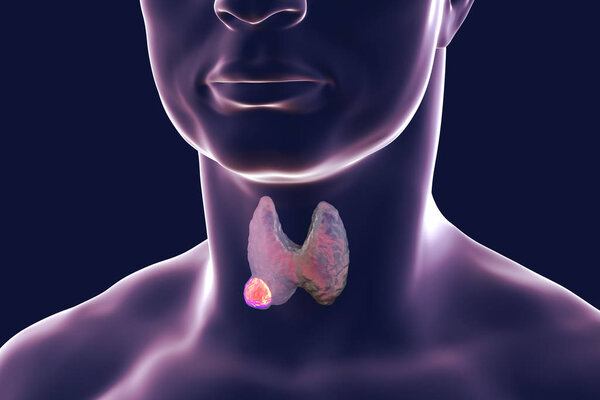 Thyroid cancer. illustration