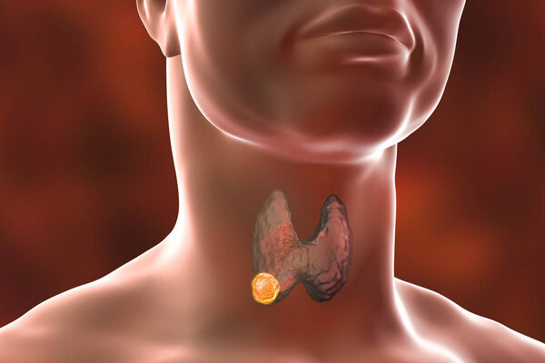 Thyroid cancer. illustration