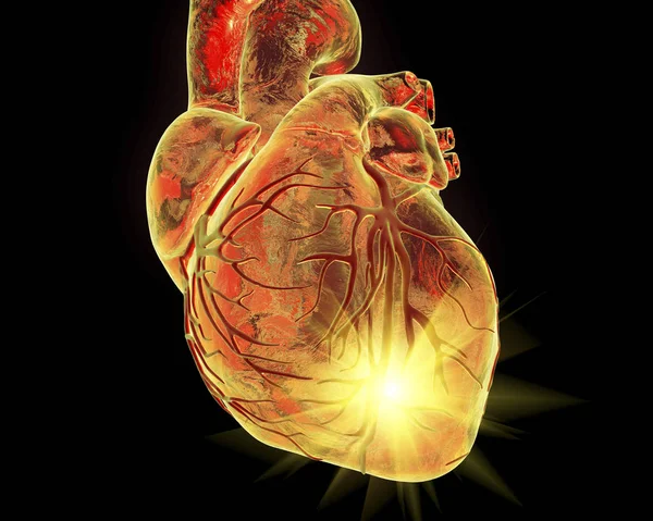 Infarto cardiaco, illustrazione coneptual — Foto Stock