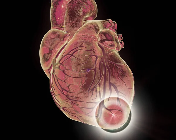 Infarto cardiaco, illustrazione coneptual — Foto Stock