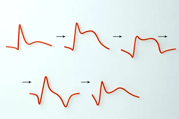 Ecg bei Myokardinfarkt, Illustration, die die Evolution der ecg mit der Zeit zeigt — Stockfoto