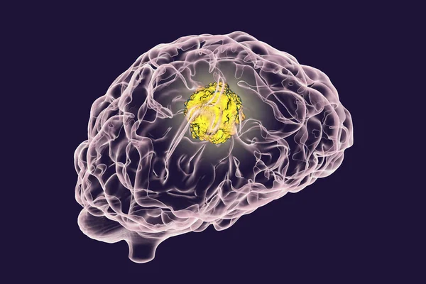 Tumor otak, ilustrasi — Stok Foto