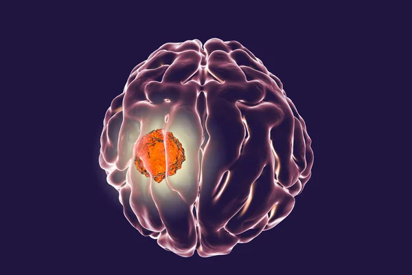 Guza mózgu, ilustracja — Zdjęcie stockowe