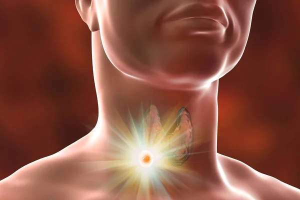 Уничтожение опухоли щитовидной железы — стоковое фото