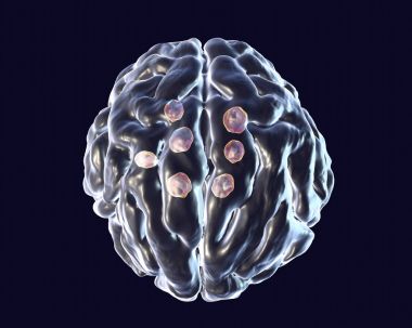 Birden çok cryptococcal kistler beyin