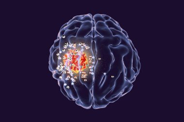 Destruction of brain tumor by nanoparticles clipart