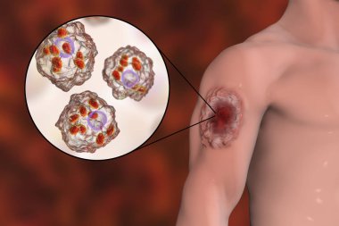 Kutanöz leishmaniasis ülser ve yakın çekim LEISHMANIA amastigotes görünümünü