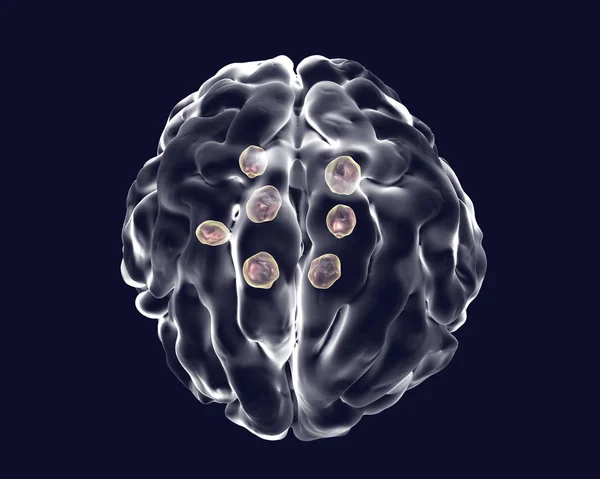 大脑中的多个新型隐球菌性囊肿 — 图库照片