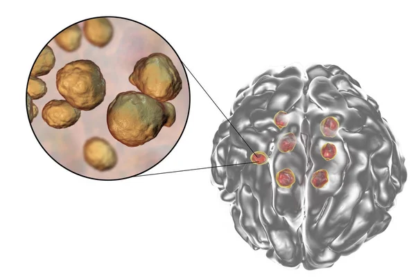 大脑中的多个新型隐球菌性囊肿 — 图库照片