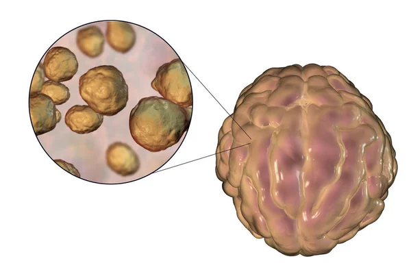 脑膜炎感染由真菌引起的新生隐球菌 — 图库照片
