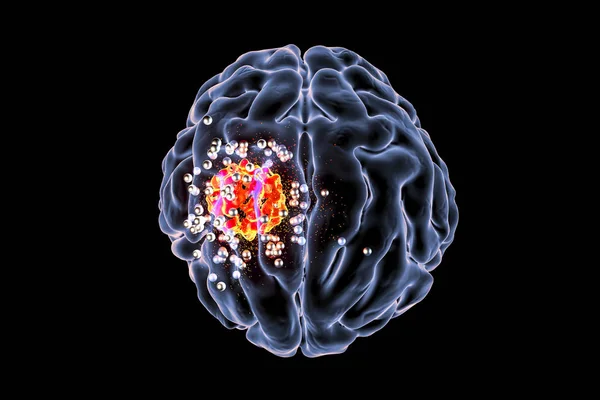 Destrucción del tumor cerebral por nanopartículas — Foto de Stock
