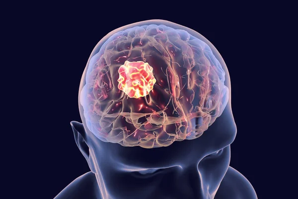 Rak mózgu, ilustracja — Zdjęcie stockowe
