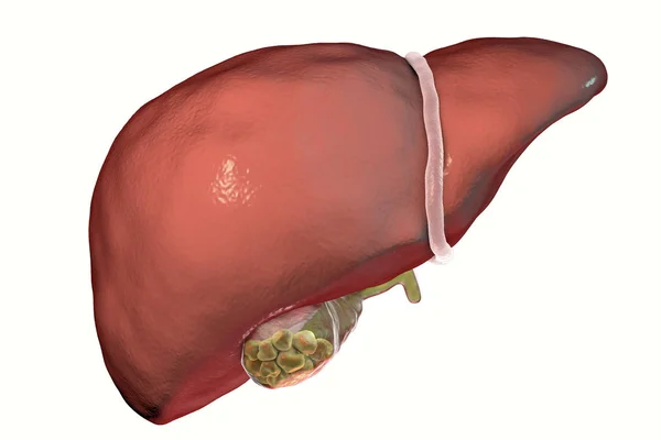 Gallstones, illustration showing front view of liver and gallbladder with stones — Stock Photo, Image