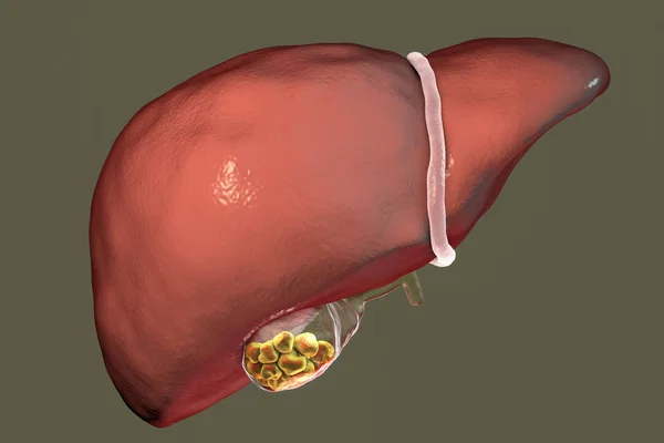 Galstenen, illustratie vooraanzicht van lever en galblaas met stenen — Stockfoto