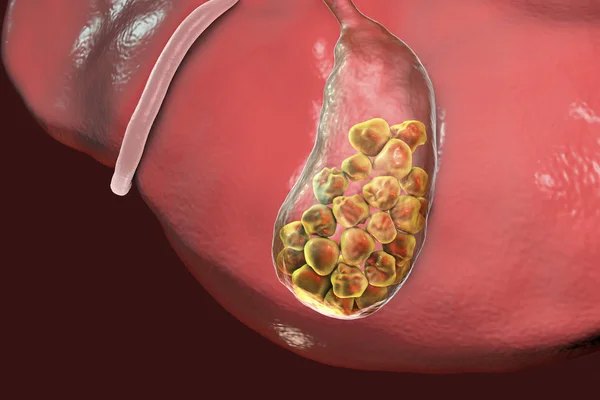 Pedras biliares, ilustração mostrando vista inferior do fígado e vesícula biliar com pedras — Fotografia de Stock