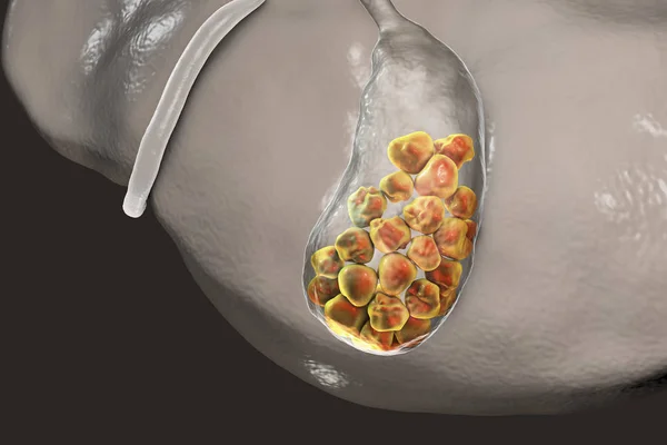 胆结石，插图显示底部视图的肝脏和胆囊结石 — 图库照片
