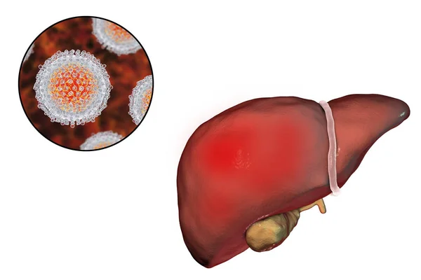 Hígado con infección por Hepatitis C y vista de cerca del virus de la Hepatitis C — Foto de Stock