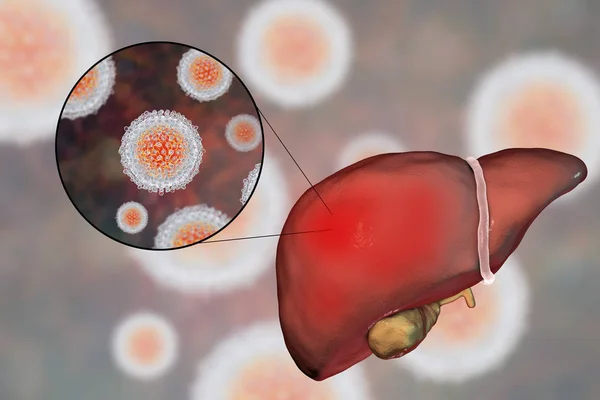 Leber mit Hepatitis-C-Infektion und Nahaufnahme des Hepatitis-C-Virus — Stockfoto