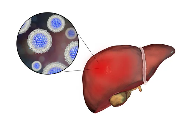 Hígado con infección por Hepatitis C y vista de cerca del virus de la Hepatitis C —  Fotos de Stock