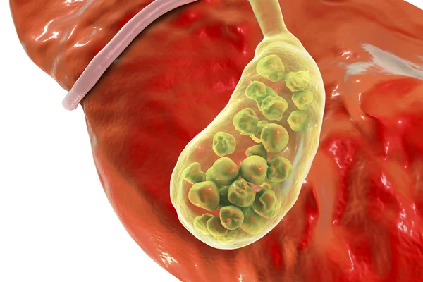 Gallstones, illustration showing bottom view of liver and gallbladder with stones — Stock Photo, Image