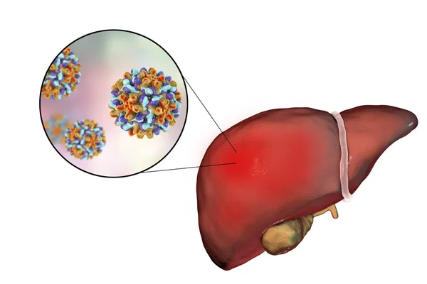 Hígado con infección por Hepatitis B y vista de cerca del virus de la Hepatitis B — Foto de Stock