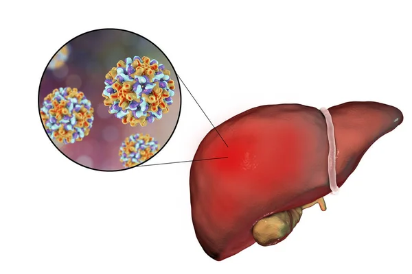 Hígado con infección por Hepatitis B y vista de cerca del virus de la Hepatitis B — Foto de Stock