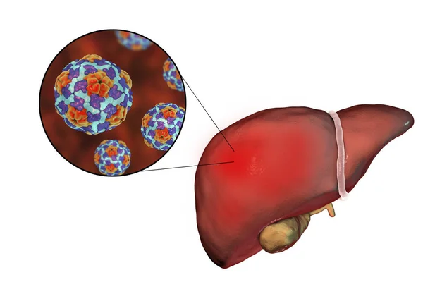 Liver with Hepatitis A infection and close-up view of Hepatitis A Virus