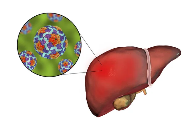 Hígado con infección por Hepatitis A y vista de cerca del virus de la Hepatitis A —  Fotos de Stock