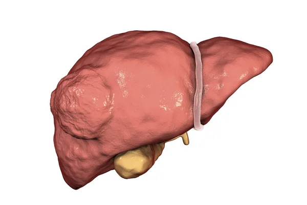 Ilustración del cáncer de hígado —  Fotos de Stock