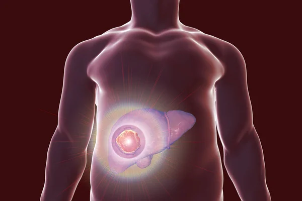 Liver cancer treatment concept — Stock Photo, Image