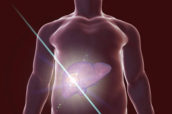 Conceptul de tratament al cancerului hepatic — Fotografie, imagine de stoc