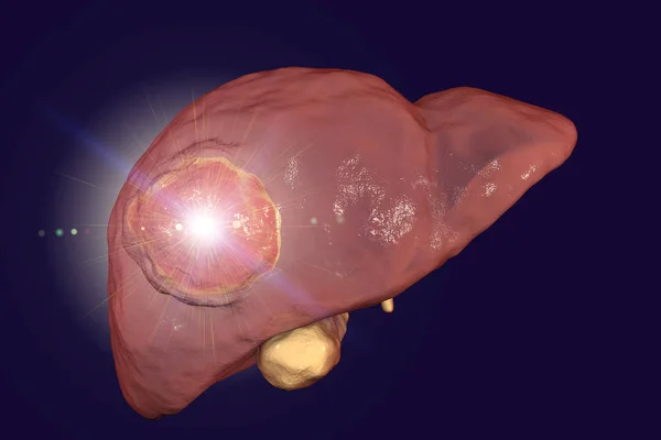 Liver cancer treatment concept