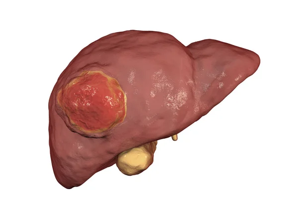 Ilustración del cáncer de hígado — Foto de Stock