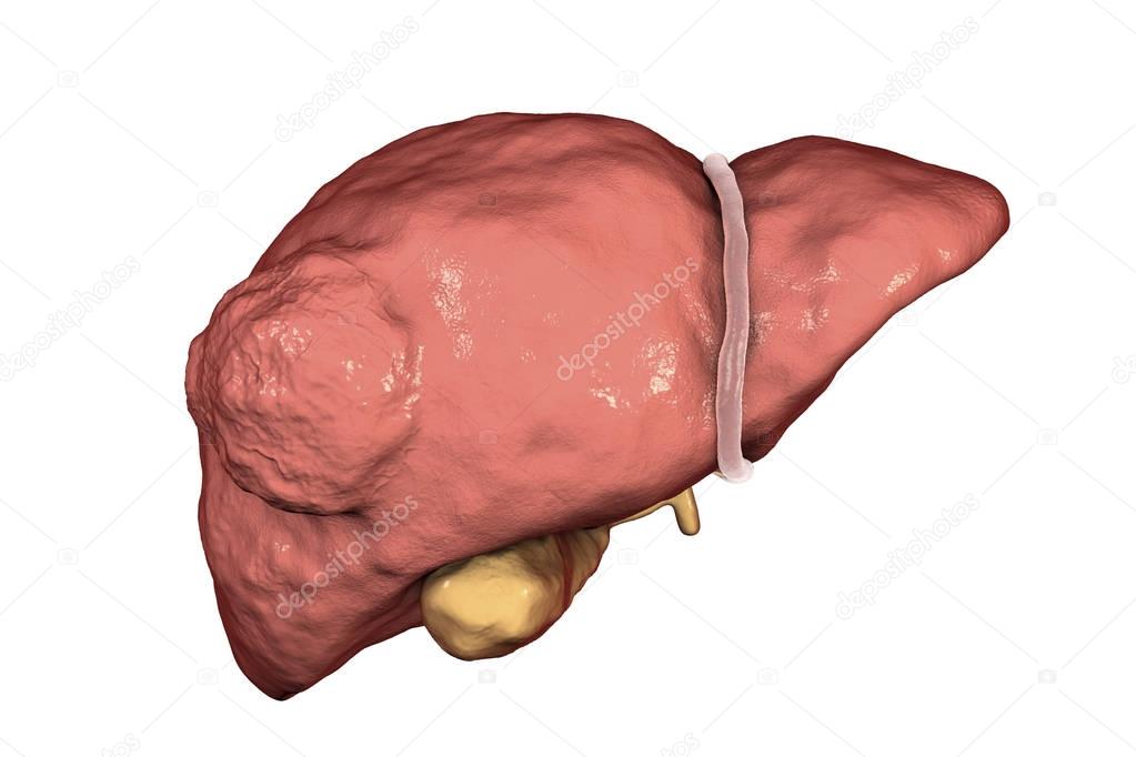 Liver cancer illustration