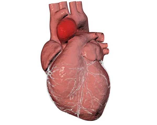 Aneurismo dell'aorta ascendente — Foto Stock
