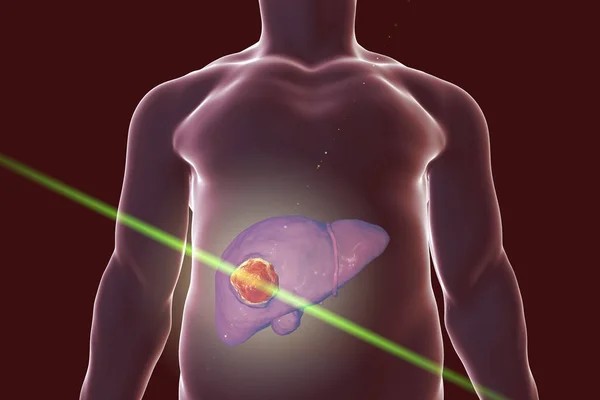 Liver cancer treatment concept