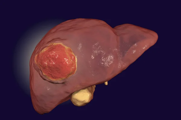 Liver cancer illustration