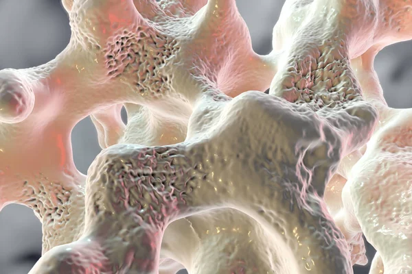 Spongy bone tissue affected by osteoporosis