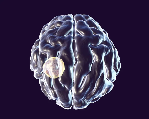 寄生虫トキソ プラズマ原虫によって引き起こされる脳膿瘍 — ストック写真