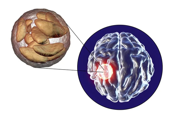 Absceso cerebral causado por protozoos parásitos Toxoplasma gondii — Foto de Stock