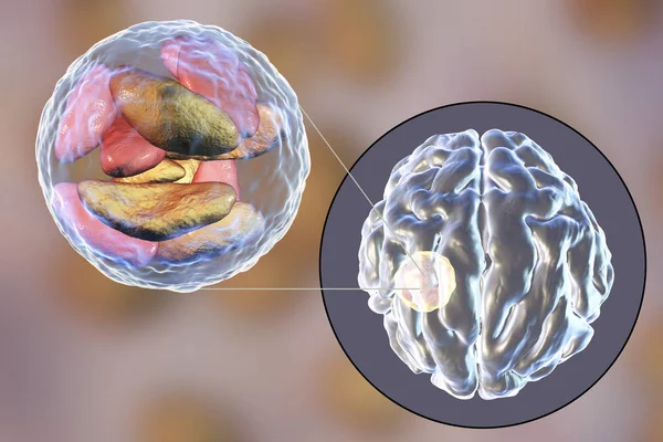 Ropień mózgu spowodowane przez pasożytnicze pierwotniaki Toxoplasma gondii — Zdjęcie stockowe