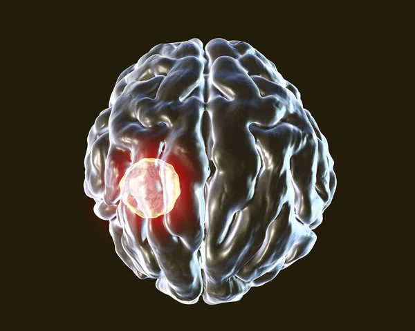 Абсцес мозку, викликаний паразитом Токсоплазма гондіда — стокове фото